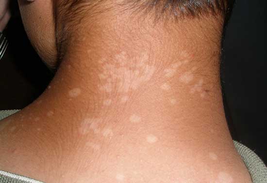 Photo showing tinea versicolor skin fungus which can be treated with bee propolis cream