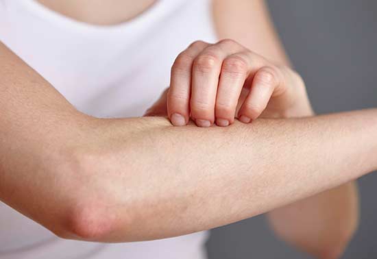 Photo showing itchy hand, showing bee Propolis Cream Treats Inflammation