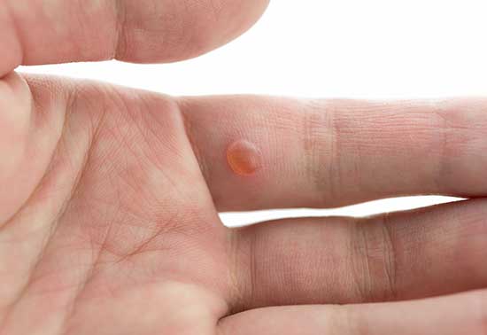 photo of hand wart, showing bee propolis cream treats warts