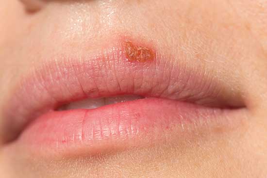 photo of cold sore, showing bee propolis cream treats hsi-1 virus